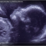 Melissa Moore’s ultrasound sonogram. Taken from her YouTube video