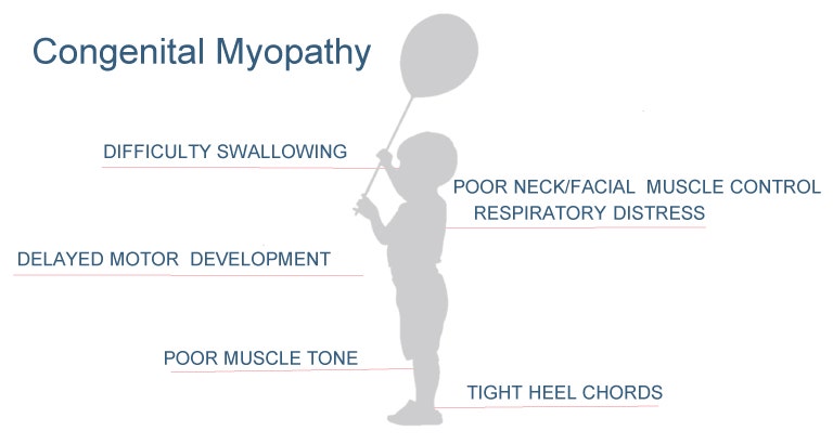 Congenital myopathy causes a number of symptoms, often presenting at birth.