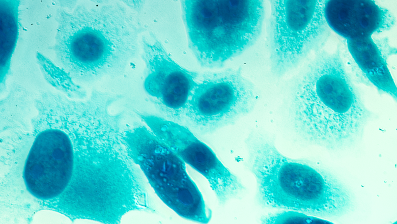 PC-3 human prostate cancer cells, stained with Coomassie blue, under differential interference contrast microscope