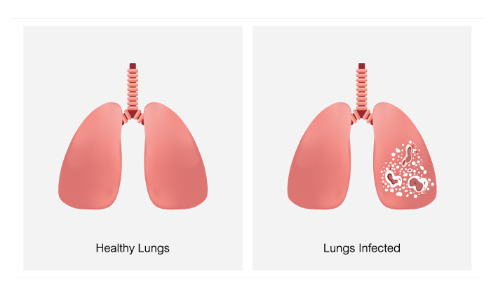 Healthy Lugs vs. Bacterial Lung Infection