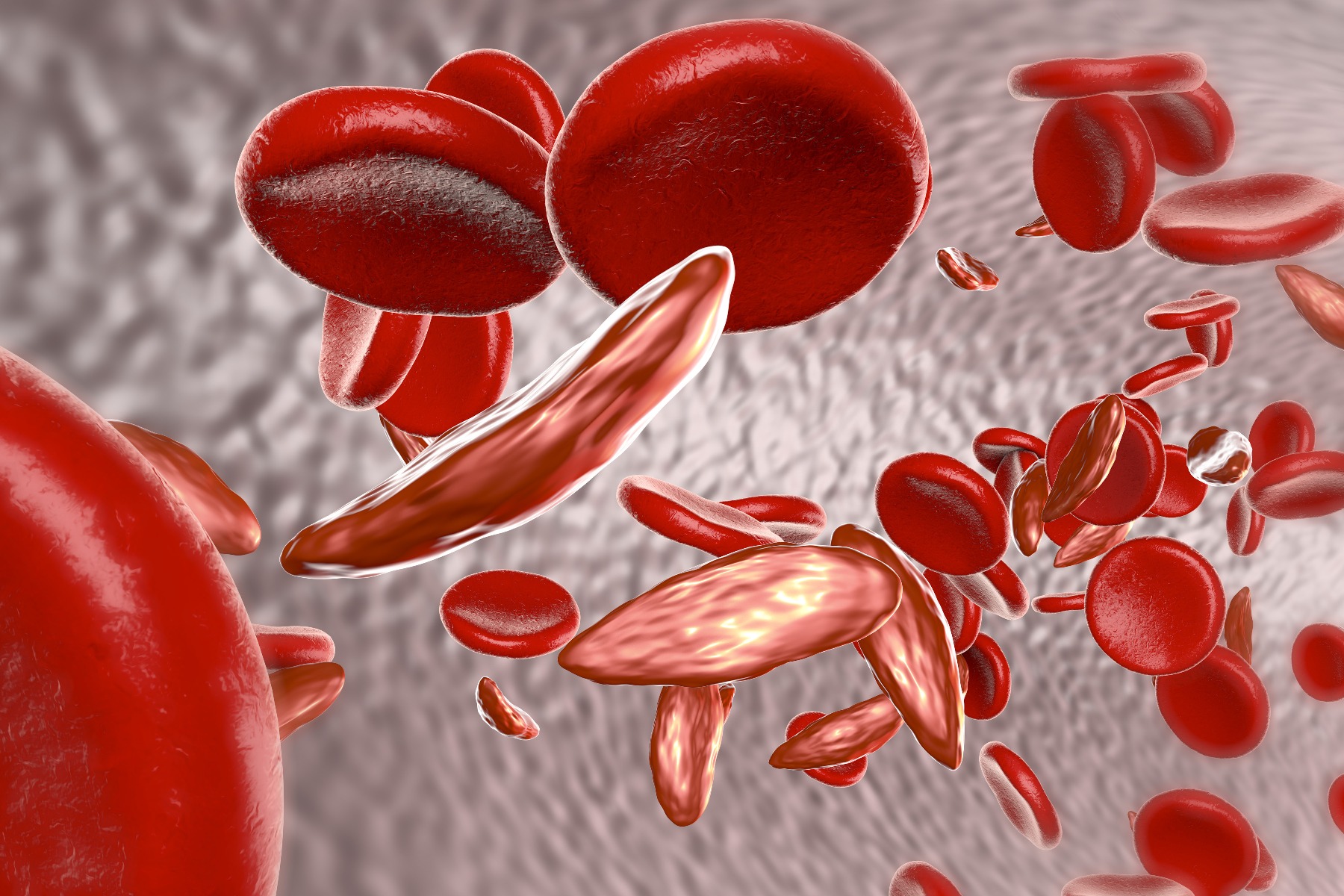 Sickle-Cell Anemia Illustration